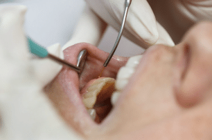 dental veneers Diabetes and Gum Disease: What You Need to Know